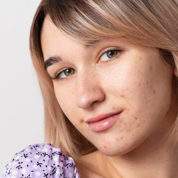 akné žena ruska